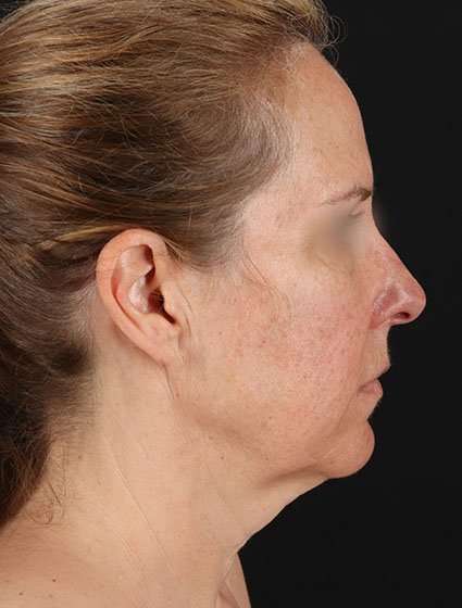 Face & Neck Lift Before & After Patient #3270