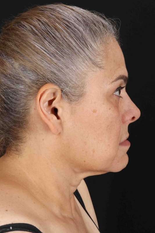 Face & Neck Lift Before & After Patient #3292