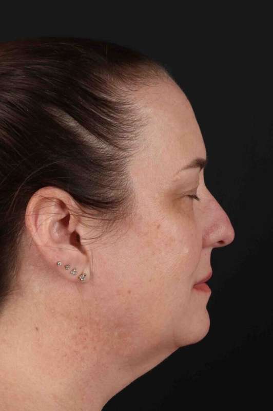 Face & Neck Lift Before & After Patient #3303