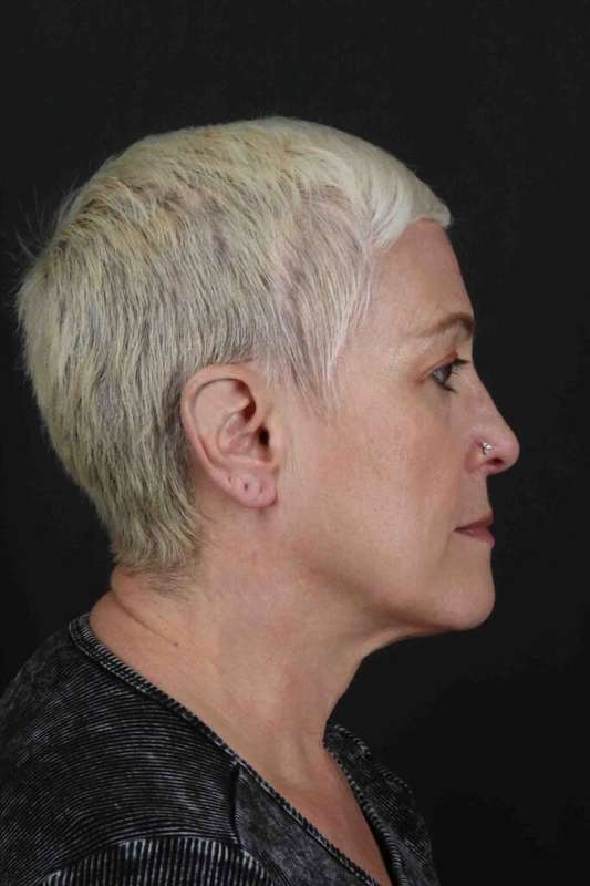 Face & Neck Lift Before & After Patient #3314