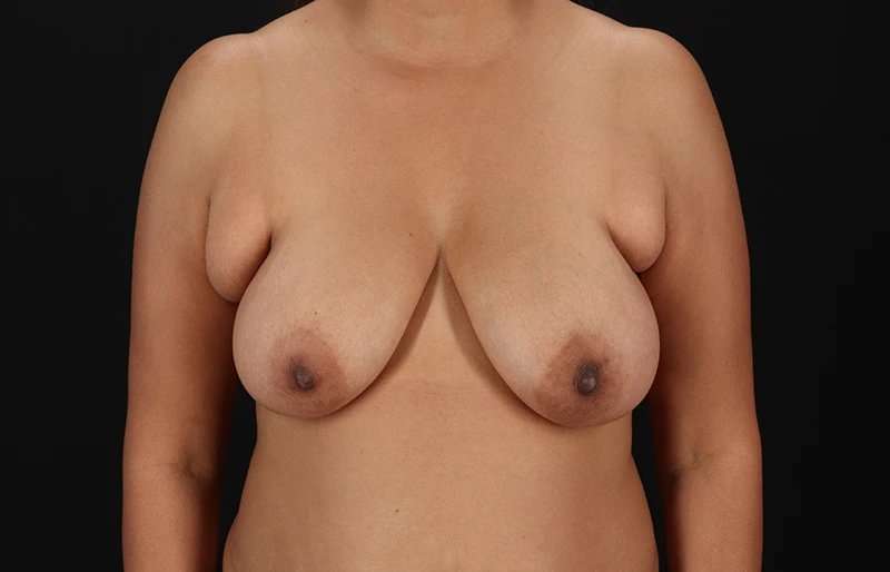 Breast Lift Before & After Patient #1149