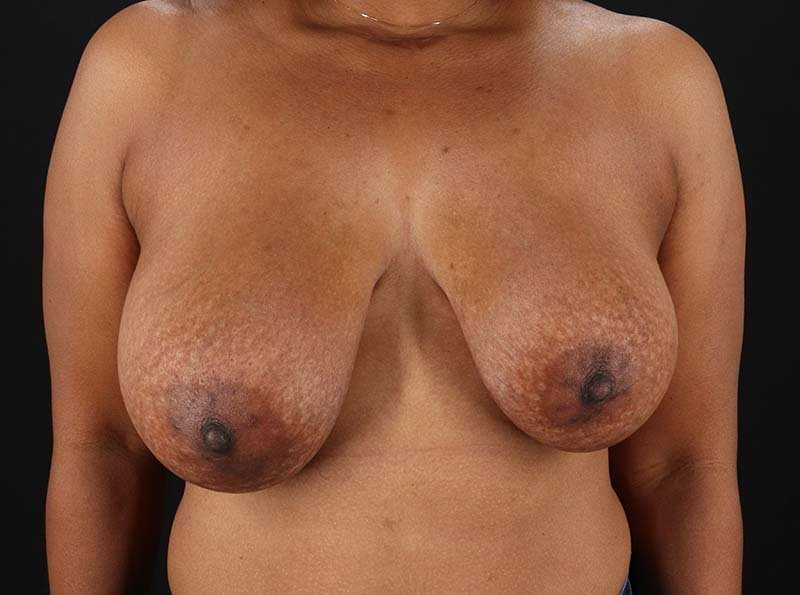 Breast Reduction Before & After Patient #1217