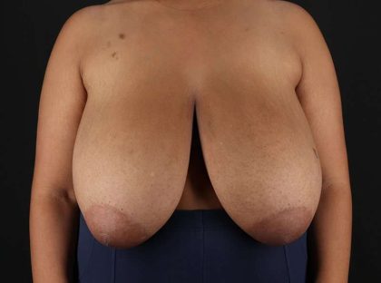 Breast Reduction Before & After Patient #1228