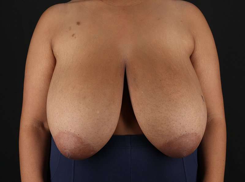 Breast Reduction Before & After Patient #1228