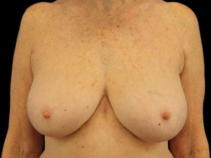 Breast Reduction Before & After Patient #1239