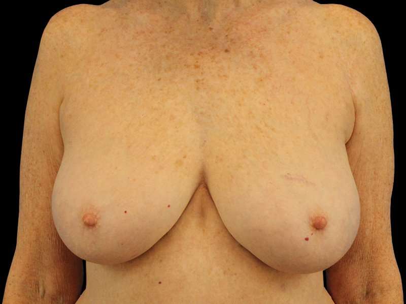 Breast Reduction Before & After Patient #1239