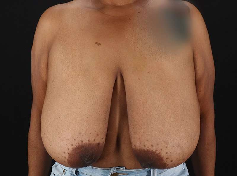 Breast Reduction Before & After Patient #1272