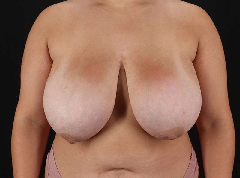 Breast Reduction Before & After Patient #1283