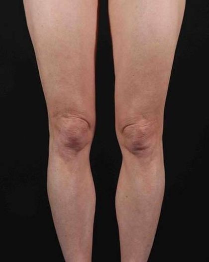 Quantum Rf Before & After Patient #925
