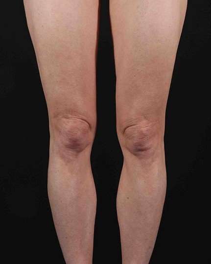 Quantum Rf Before & After Patient #925