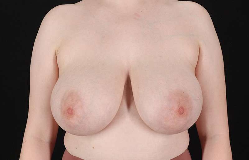 Breast Reduction Before & After Patient #1310