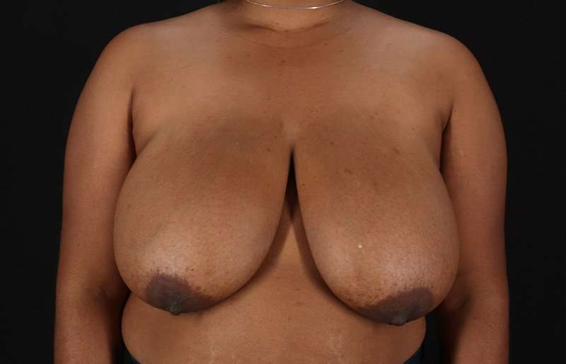 Breast Reduction Before & After Patient #1431