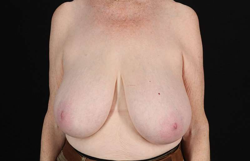 Breast Reduction Before & After Patient #1442