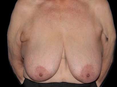 Breast Reduction Before & After Patient #1464