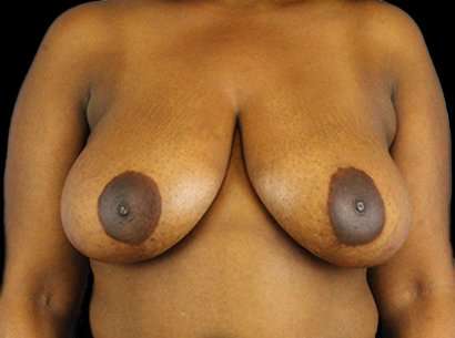 Breast Reduction Before & After Patient #1475