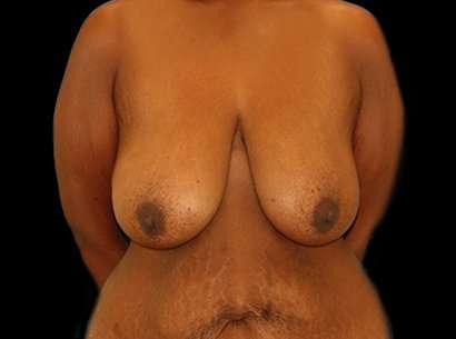 Breast Reduction Before & After Patient #1486