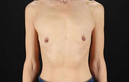 Breast Augmentation - Implant Before & After Patient #943