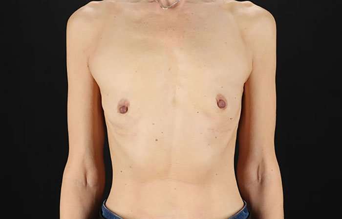 Breast Augmentation - Implant Before & After Patient #943