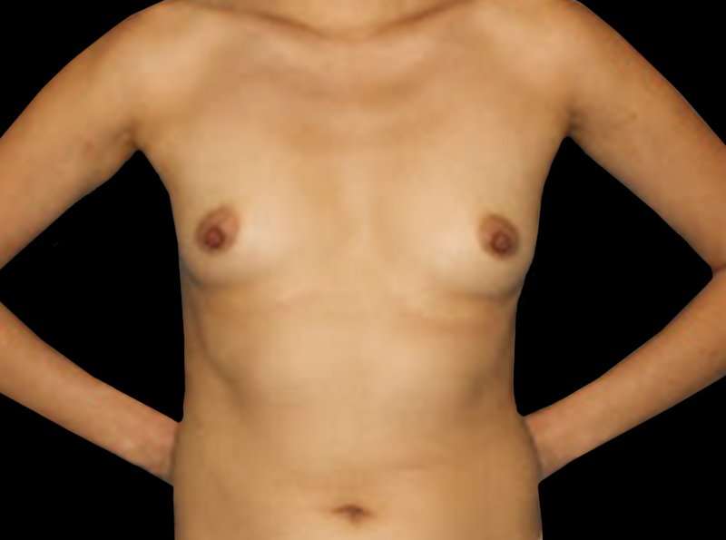 Breast Augmentation - Fat Transfer Before & After Patient #1511