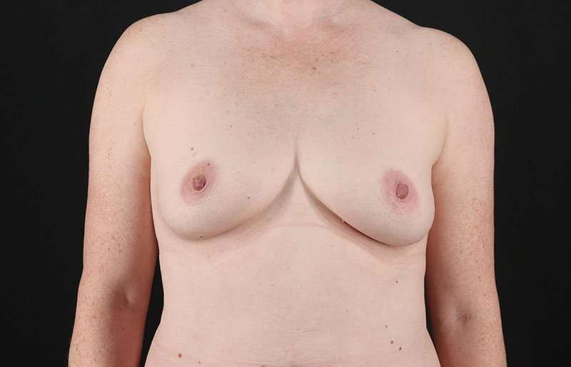 Breast Augmentation - Fat Transfer Before & After Patient #1533