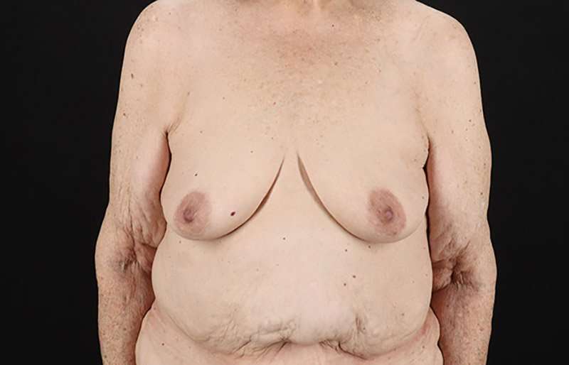 Augmentation/Lift Before & After Patient #1544