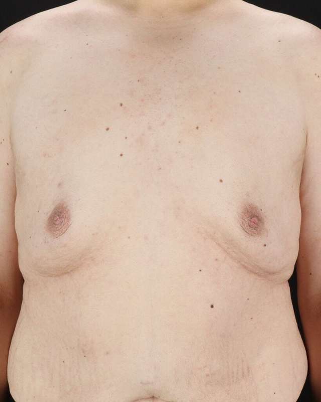 Gynecomastia Before & After Patient #1603