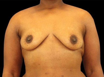 Breast Augmentation - Implant Before & After Patient #954
