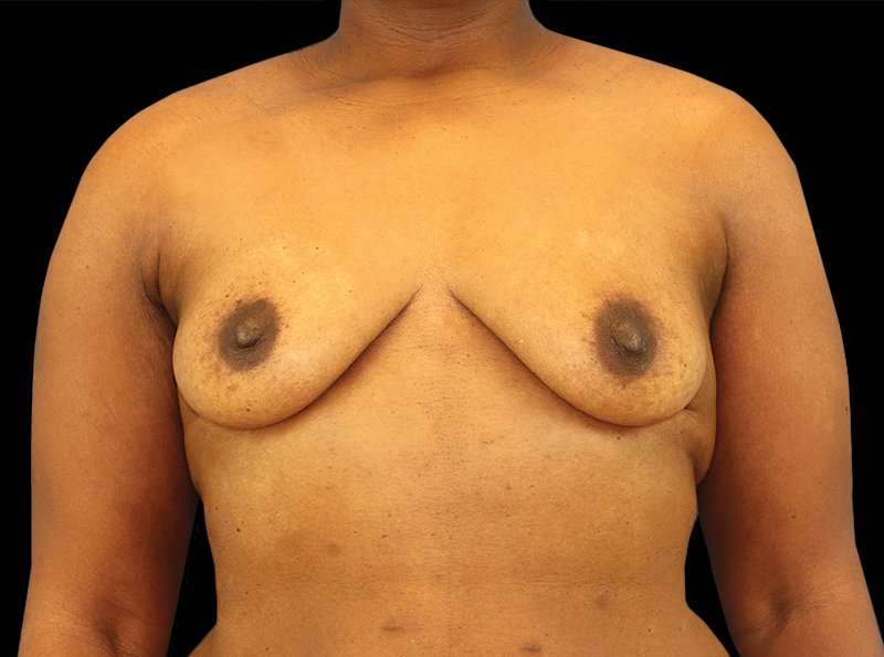 Breast Augmentation - Implant Before & After Patient #954