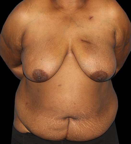 DIEP Flap Reconstruction Before & After Patient #1623