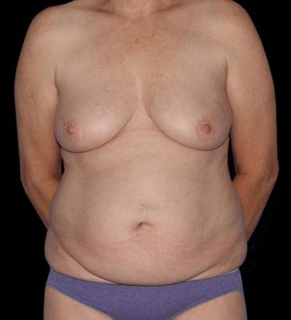 DIEP Flap Reconstruction Before & After Patient #1634