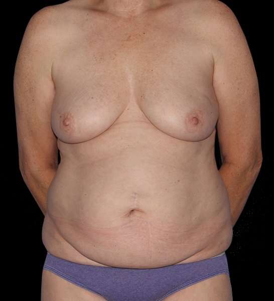 DIEP Flap Reconstruction Before & After Patient #1634