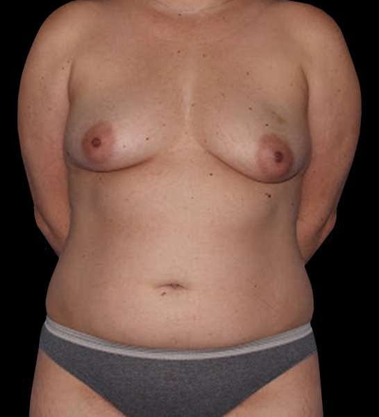 DIEP Flap Reconstruction Before & After Patient #1645
