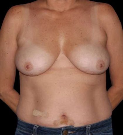 DIEP Flap Reconstruction Before & After Patient #1652