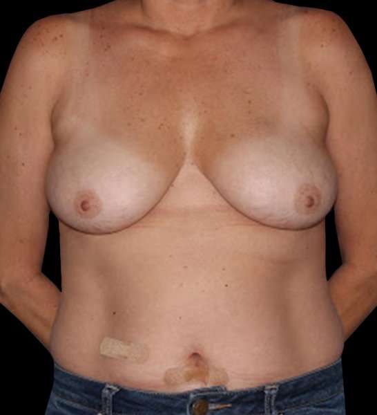 DIEP Flap Reconstruction Before & After Patient #1652