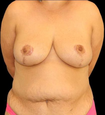 DIEP Flap Reconstruction Before & After Patient #1663