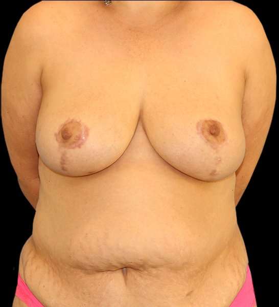 DIEP Flap Reconstruction Before & After Patient #1663
