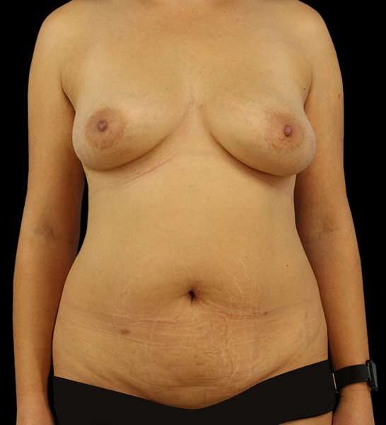 DIEP Flap Reconstruction Before & After Patient #1685