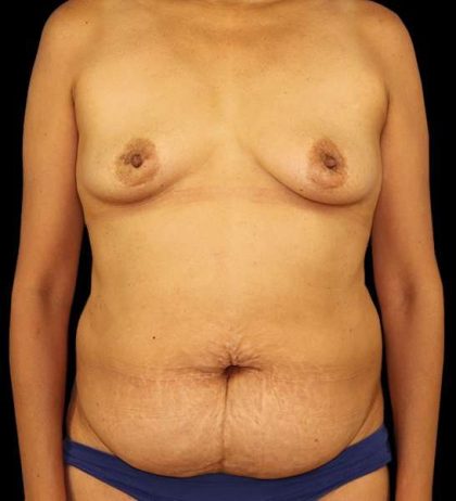 DIEP Flap Reconstruction Before & After Patient #1696