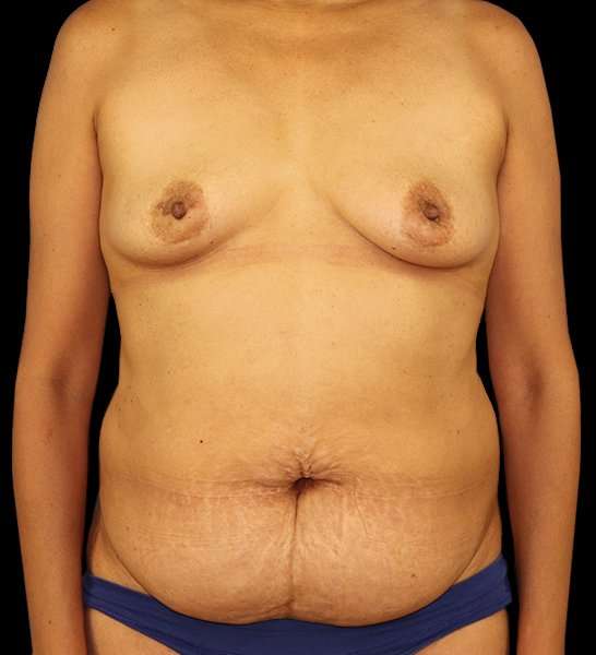 DIEP Flap Reconstruction Before & After Patient #1696