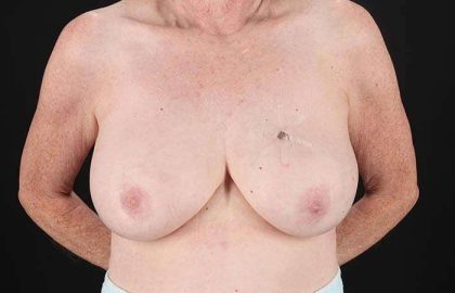 Implant Based Breast Reconstruction Before & After Patient #1718