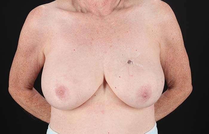 Implant Based Breast Reconstruction Before & After Patient #1718