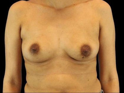 Breast Augmentation - Implant Before & After Patient #961