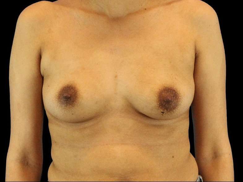 Breast Augmentation - Implant Before & After Patient #961