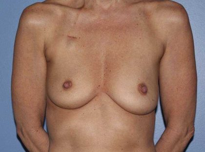 Implant Based Breast Reconstruction Before & After Patient #1729