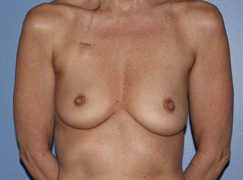 Implant Based Breast Reconstruction Before & After Patient #1729