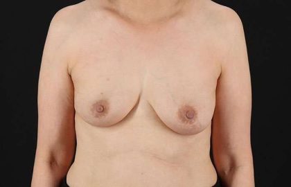 Implant Based Breast Reconstruction Before & After Patient #1740