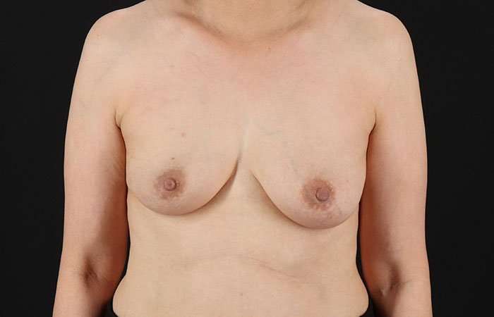 Implant Based Breast Reconstruction Before & After Patient #1740