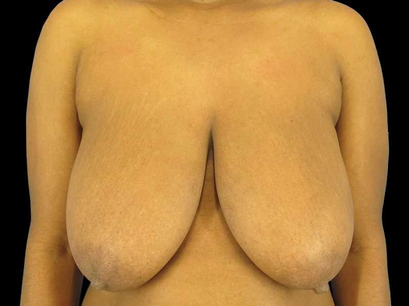 Oncoplastic Reconstruction Before & After Patient #1784