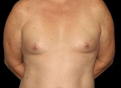 MTF Breast Augmentation Before & After Patient #1802