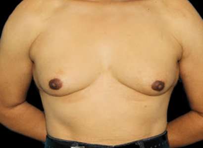 MTF Breast Augmentation Before & After Patient #1809